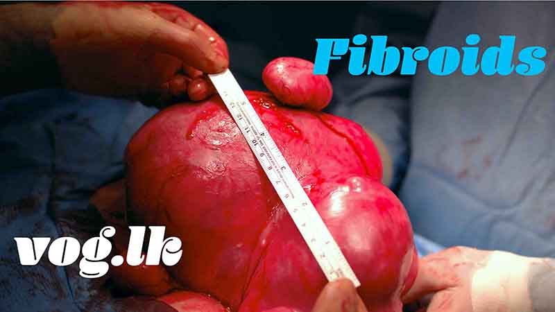 Fibroids ෆයිබ්‍රොයිඩ් ගෙඩි