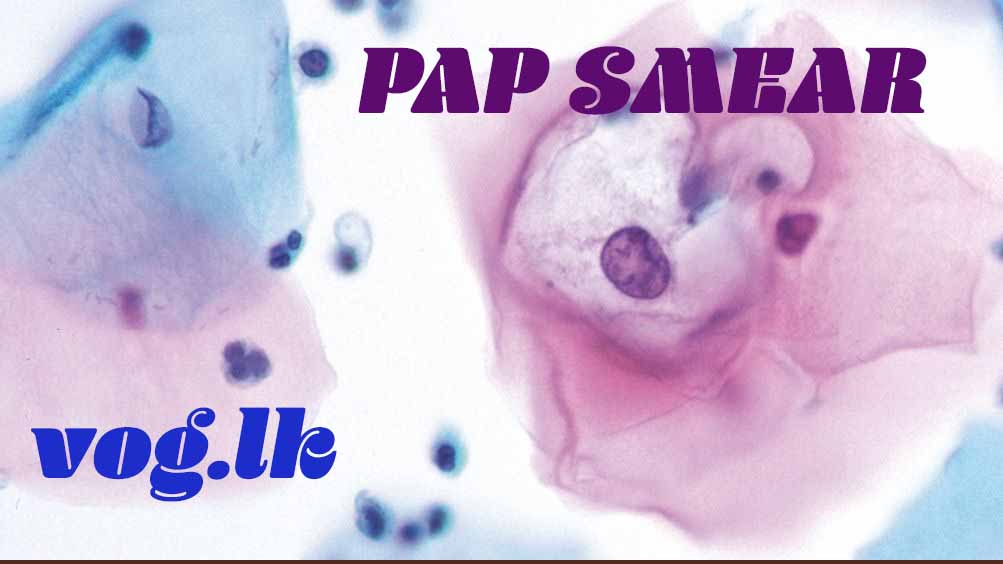 ගැබ් ගෙල පිළිකාවක් කලින් හඳුනා ගන්න PAP SMEAR TEST (ගැබ් ගෙල ස්‍රාව පරීක්ෂාව)